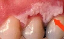 Белый прыщик на верхнем небе у грудничка. что делать если у ребенка на небе белые точки