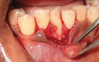 Эпулис на десне: определение, виды, фото и способы лечения
