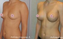 Эндоскопическое увеличение груди: как проводится и насколько безопасна такая маммопластика